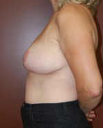 Breast Reduction