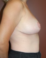 Breast Reduction