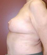 Breast Revision