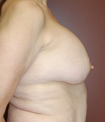 Breast Revision