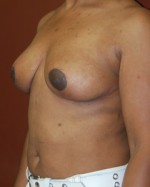 Breast Revision