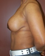 Breast Revision