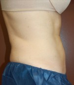 Coolsculpting