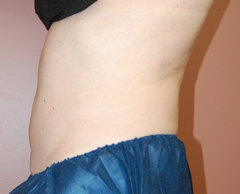 Coolsculpting