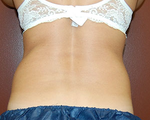 Coolsculpting