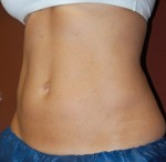 Coolsculpting