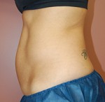 Coolsculpting