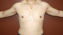 Gynecomastia - Male Breast Reduction