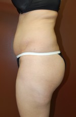 Liposuction