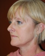 Mini Facelift