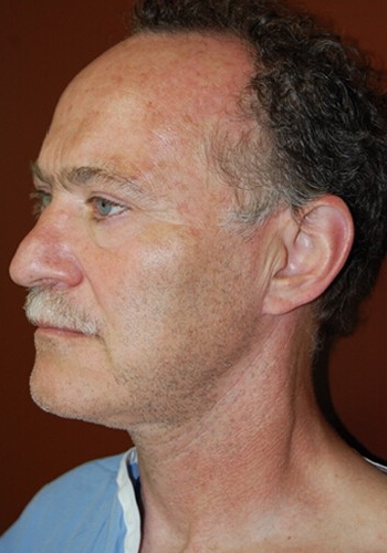Neck Lift