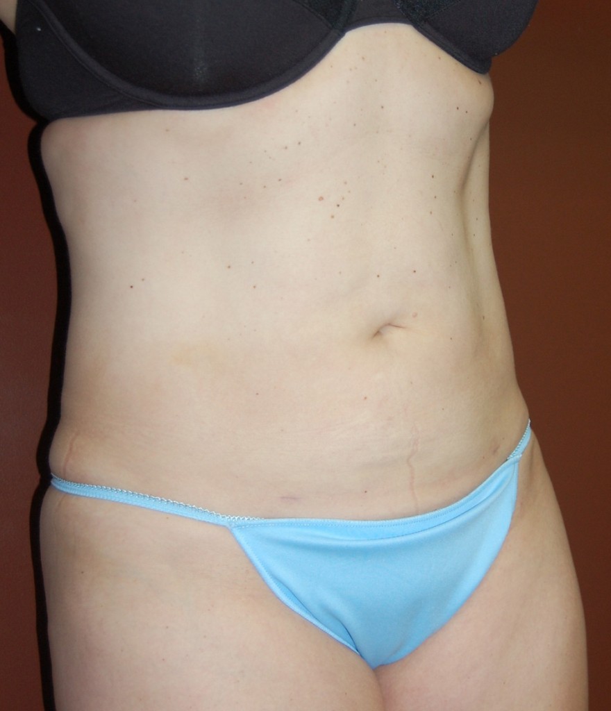 Liposuction