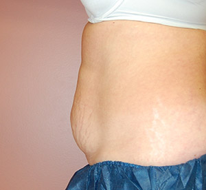 Coolsculpting