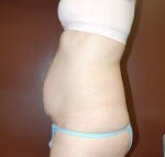 Abdominoplasty