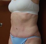 Abdominoplasty