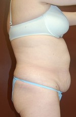 Abdominoplasty