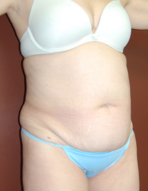 Abdominoplasty