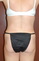 Abdominoplasty