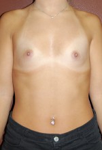 Breast Augmentation