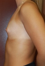 Breast Augmentation