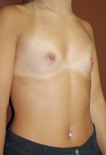 Breast Augmentation