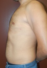 Gynecomastia - Male Breast Reduction