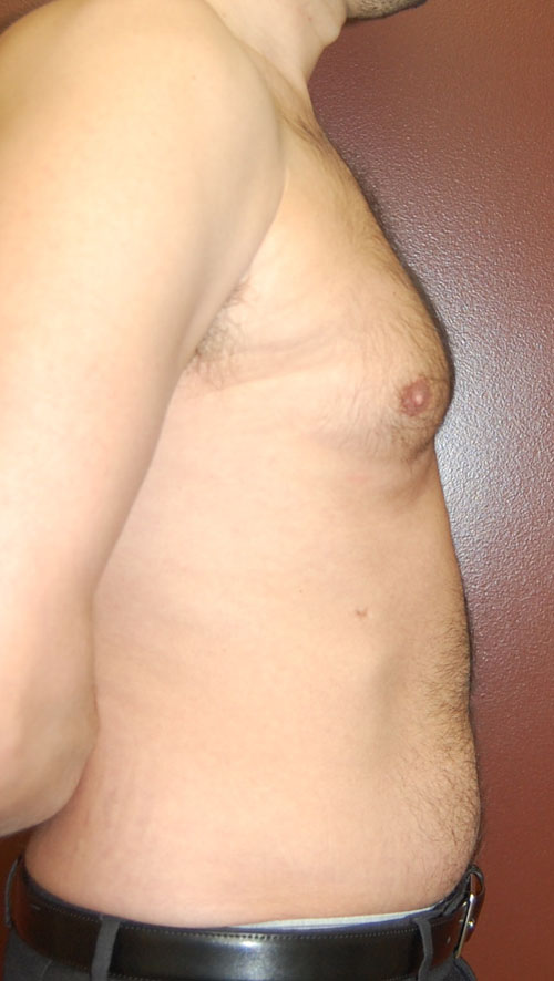 Gynecomastia - Male Breast Reduction