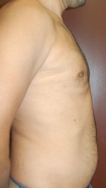 Gynecomastia - Male Breast Reduction