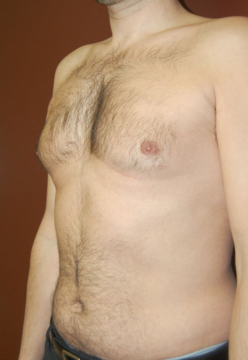 Gynecomastia - Male Breast Reduction