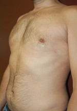 Gynecomastia - Male Breast Reduction