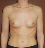 Breast Augmentation