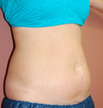 Coolsculpting