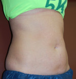 Coolsculpting