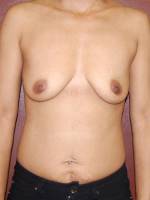 Breast Lift with Augmentation