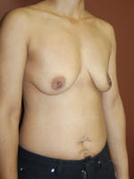 Breast Lift with Augmentation