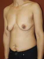 Breast Lift with Augmentation