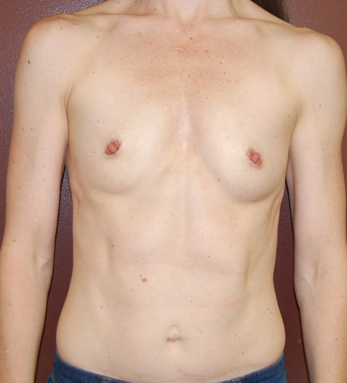 Breast Augmentation