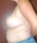 Breast Reduction