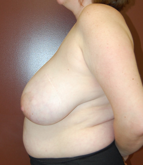 Breast Reduction