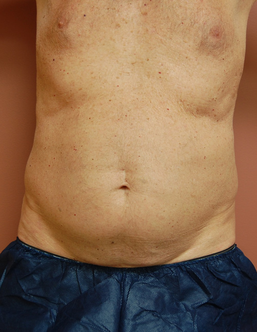 Coolsculpting