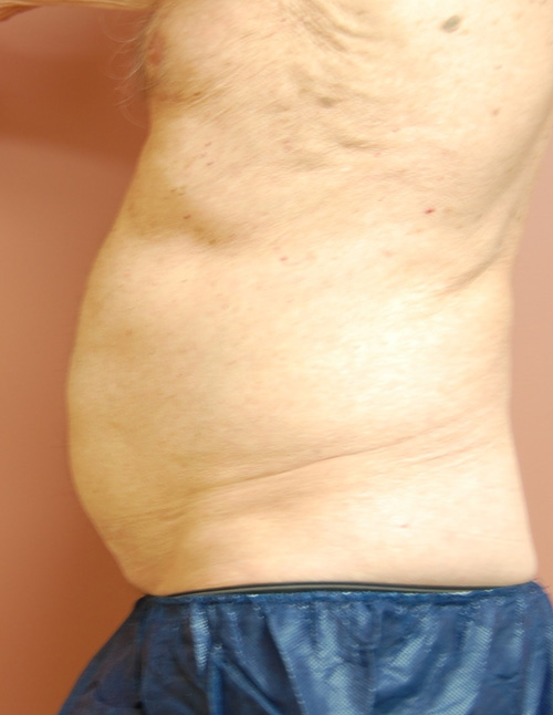 Coolsculpting