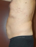 Coolsculpting