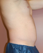 Coolsculpting