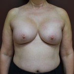 Breast Augmentation