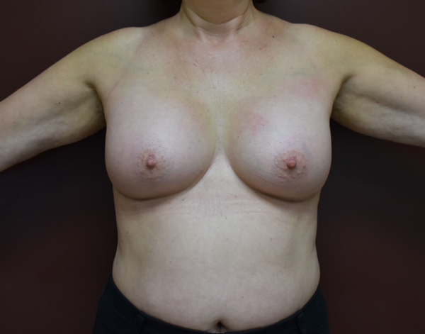 Breast Augmentation