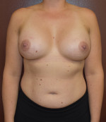 Breast Augmentation