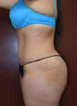 Abdominoplasty