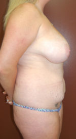 Breast Reduction