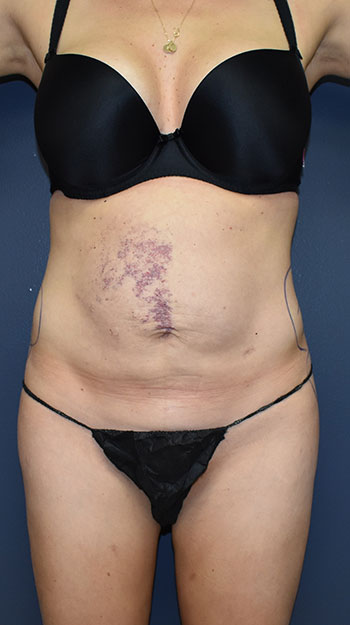 Abdominoplasty