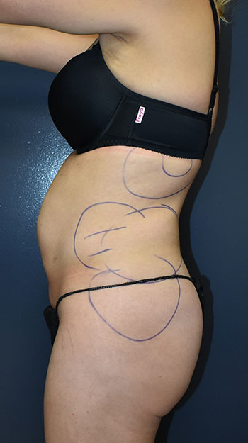 Abdominoplasty